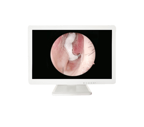 Medical HD Endoscope Monitor 21＂